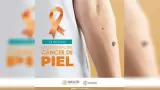 Cncer de piel
