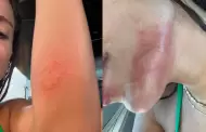 Anitta revela que sufri un ataque de medusas en Ibiza