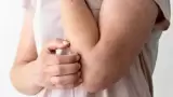 sarampión
