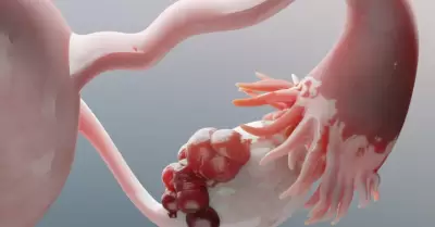 Cáncer de Ovario