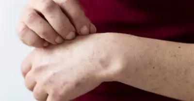 Sarampión