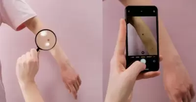 Cáncer de piel