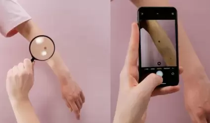 Cáncer de piel