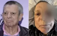 C�sar Bono pierde el ojo izquierdo tras cirug�a por tumor; espera biopsia